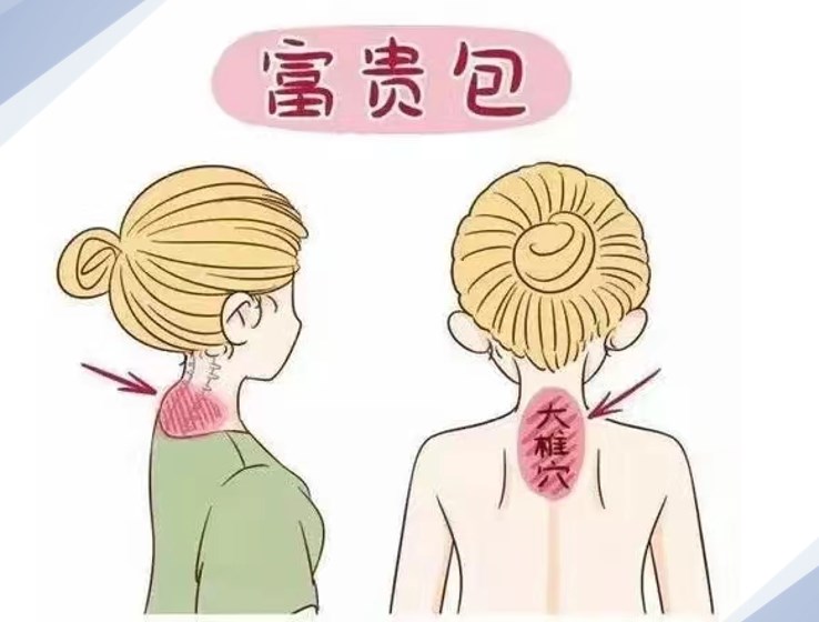 成都友谊医院治疗富贵包的技术优势是什么