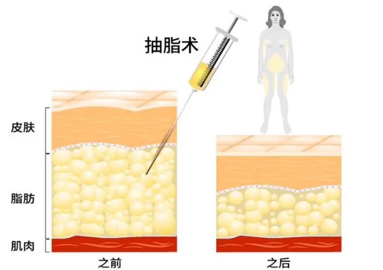 都军大腹部吸脂价格常见疑问