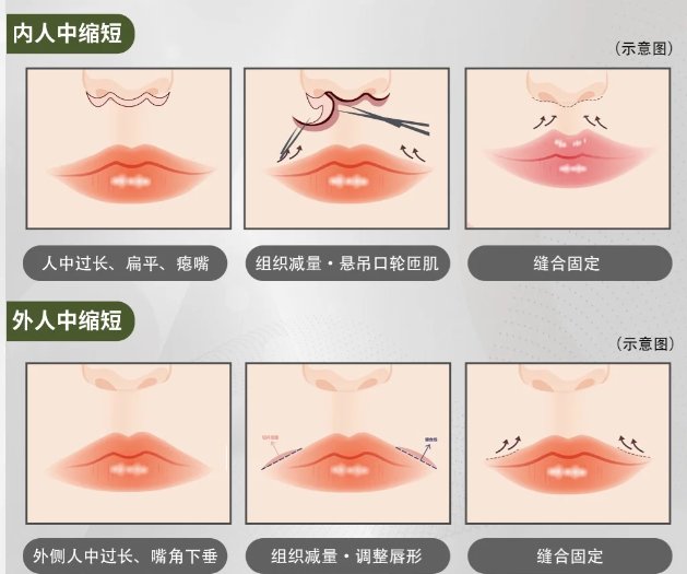 范开防的人中手术后变好指南:做好这5件事,3个月就能自然变好看