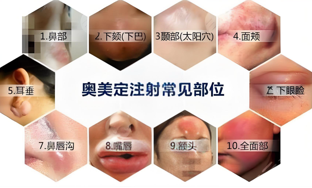 李方奇在北京奥尔贝德医疗美容