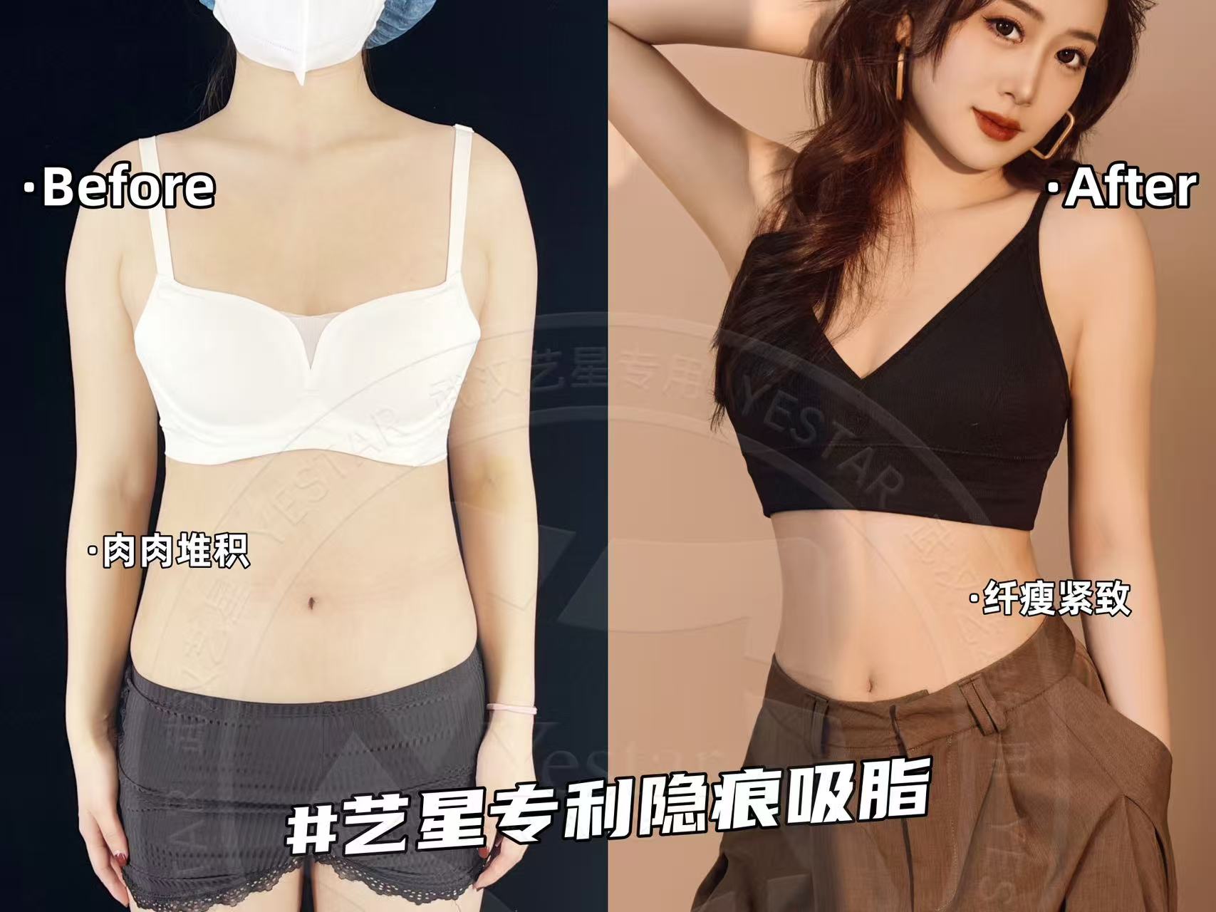 重庆胸部吸脂手术多少钱一次?军科/星荣/华美3家热门医院收费实报不坑人