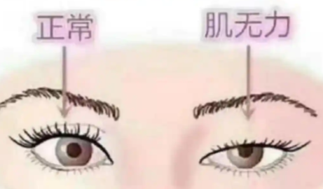 卢玲双眼皮提肌修复的价格