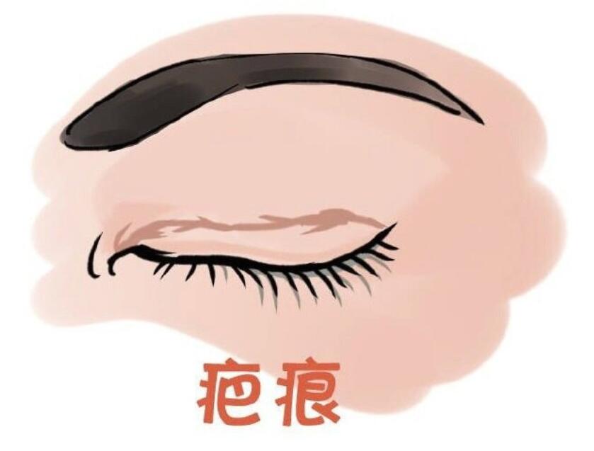 闫娇君修复双眼皮技术好