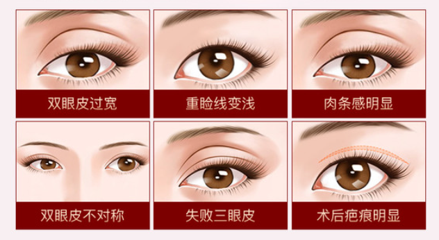 闫娇君医生修复双眼皮靠谱吗?沪上姐妹亲测:肉条眼/宽改窄修复都稳!