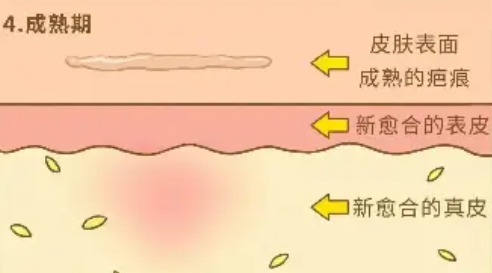 成都美容整形医院疤痕科治疤痕好