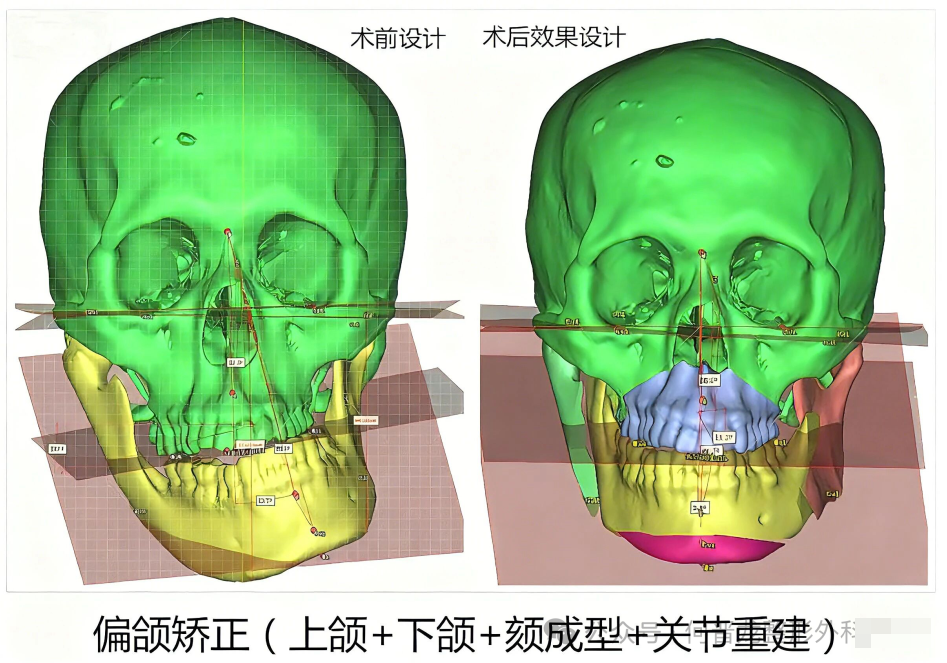 避坑必看!何晋龙正颌价格表:凸嘴6万起,地包天6.2万起,偏颌8万起,双鄂13.6万起,3D打印不瘪嘴