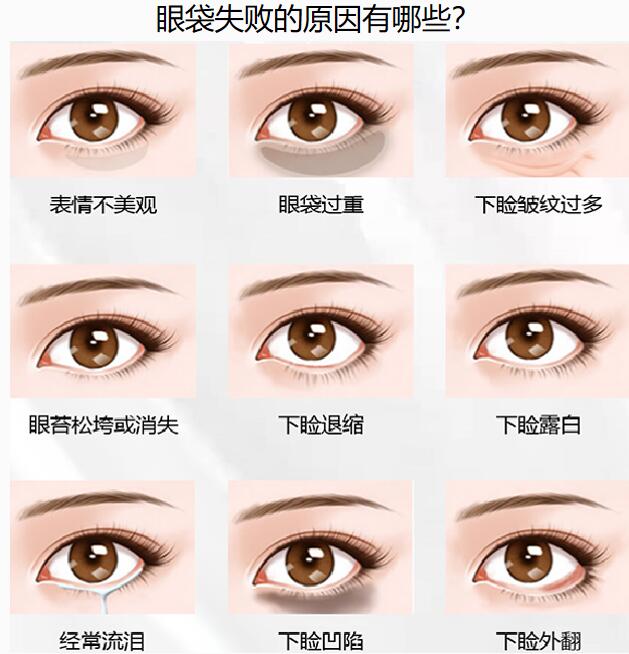 吴焱秋医生做多次失败双眼皮修复好