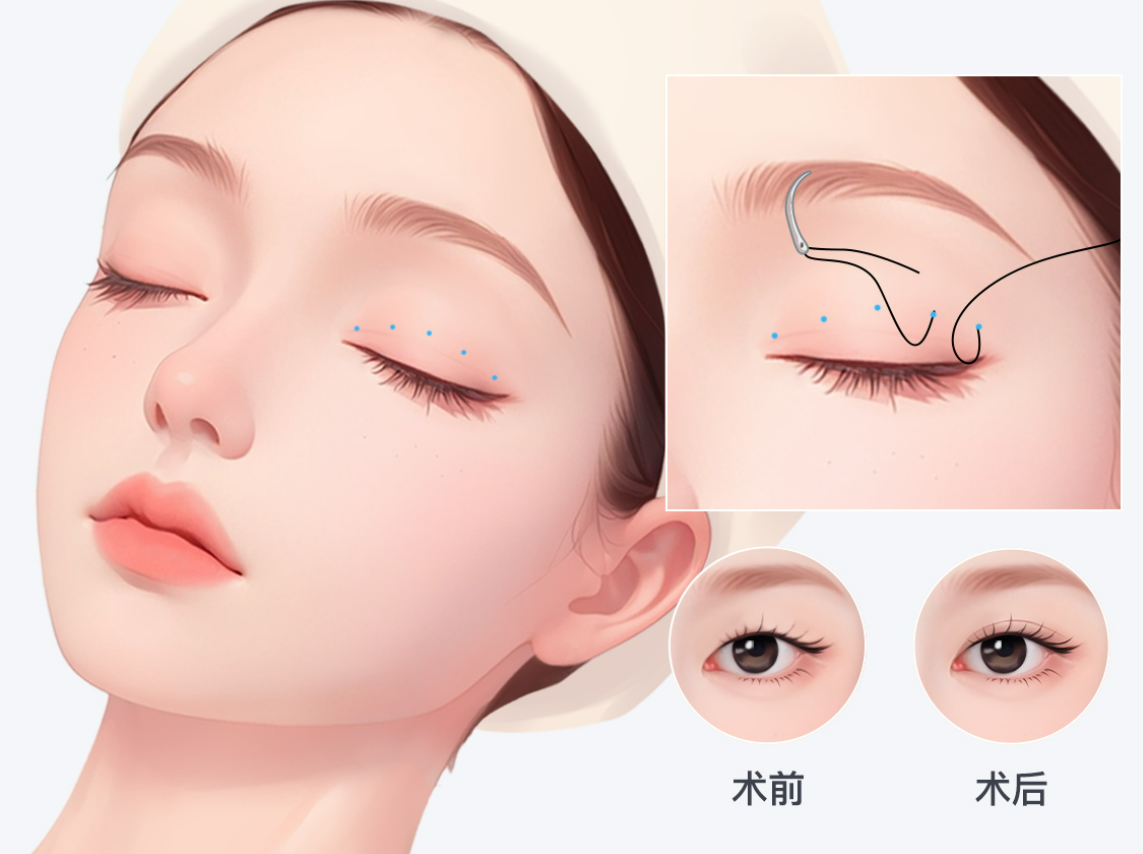 上海曾翾博士修复眼睛多少钱