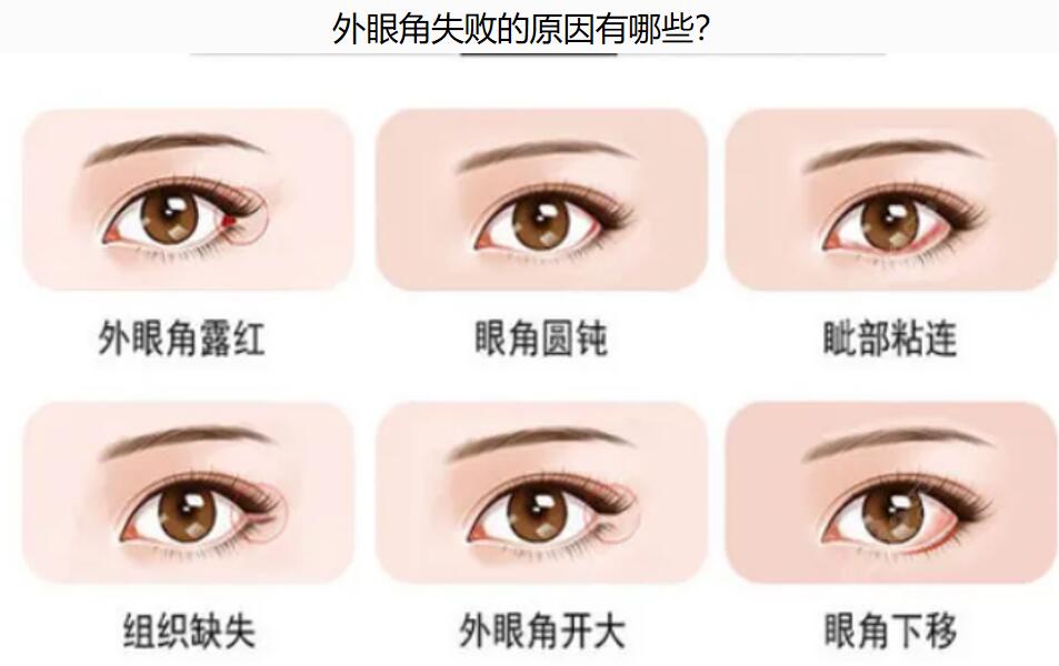 杨晨光双眼皮修复实例参考:肉条眼修复,成效符合我的预期