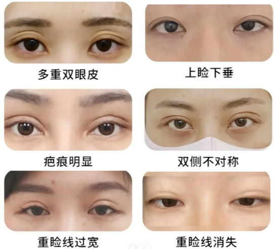 费博文荣双眼皮修复怎么样?