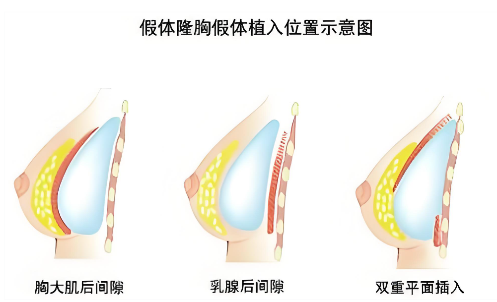 西安艺星做胸好的医生如何选择?