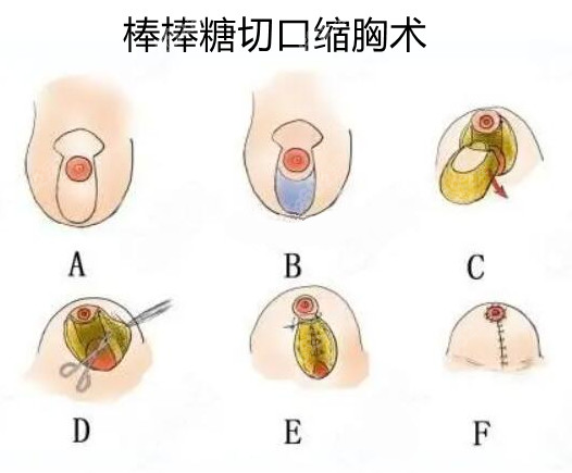 南京朱淼医生缩胸的技术怎么样?独家棒棒糖切口+双环法,疤痕隐藏于乳晕,保留哺乳功能!