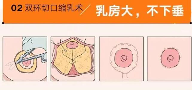 南京朱淼医生缩胸的价格:8k-1.5w明明白白,无隐形消费