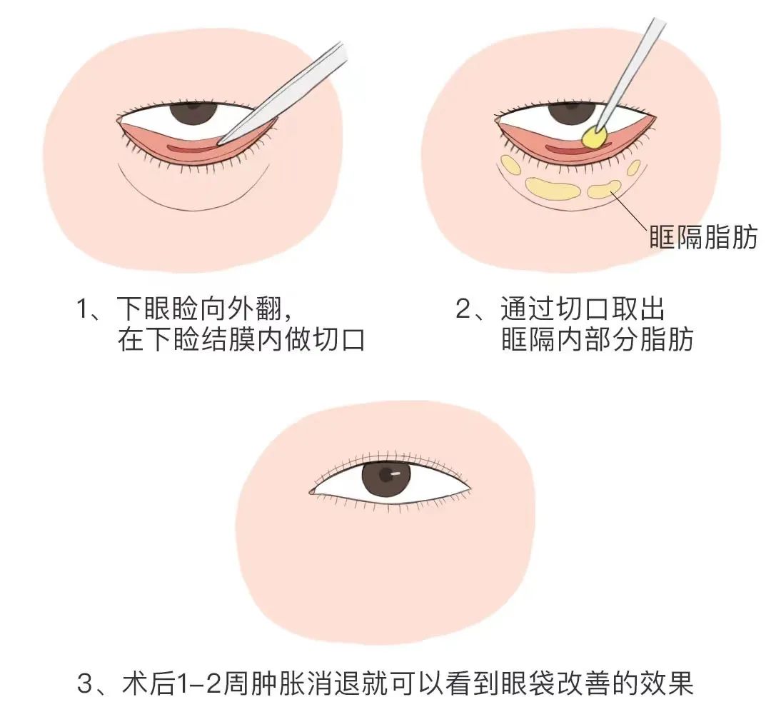 衡阳婉媄医疗:眼袋 + 紧致联合治疗,适合松弛型眼袋
