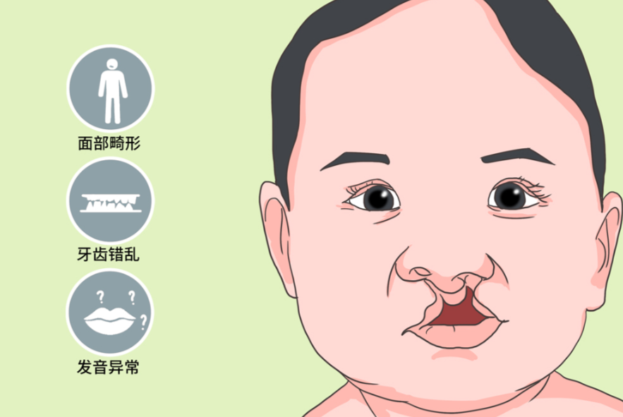 紧急求助必看!唇腭裂24小时免费线上问诊!10分钟响应,术前术后+免费手术政策全解答~