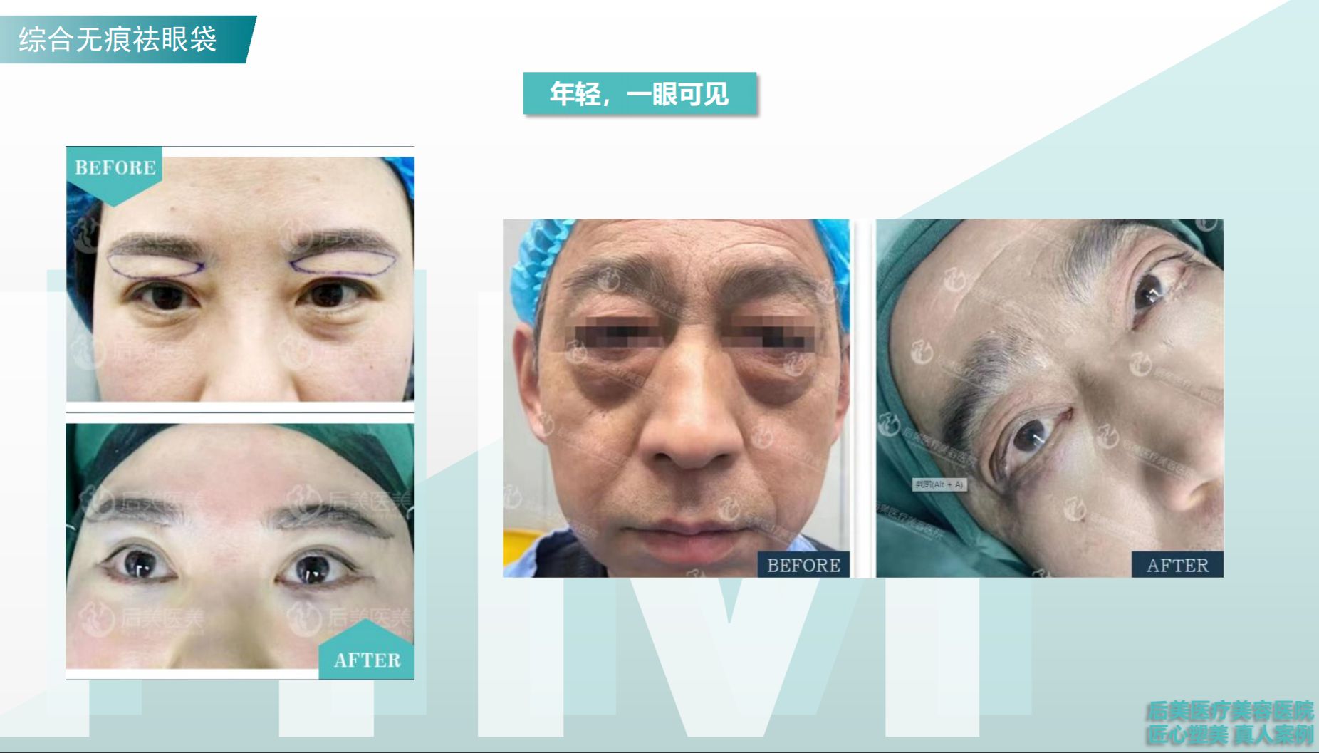 宜昌仁和医院激光去眼袋效果真实可靠吗?过来人分享亲测体验
