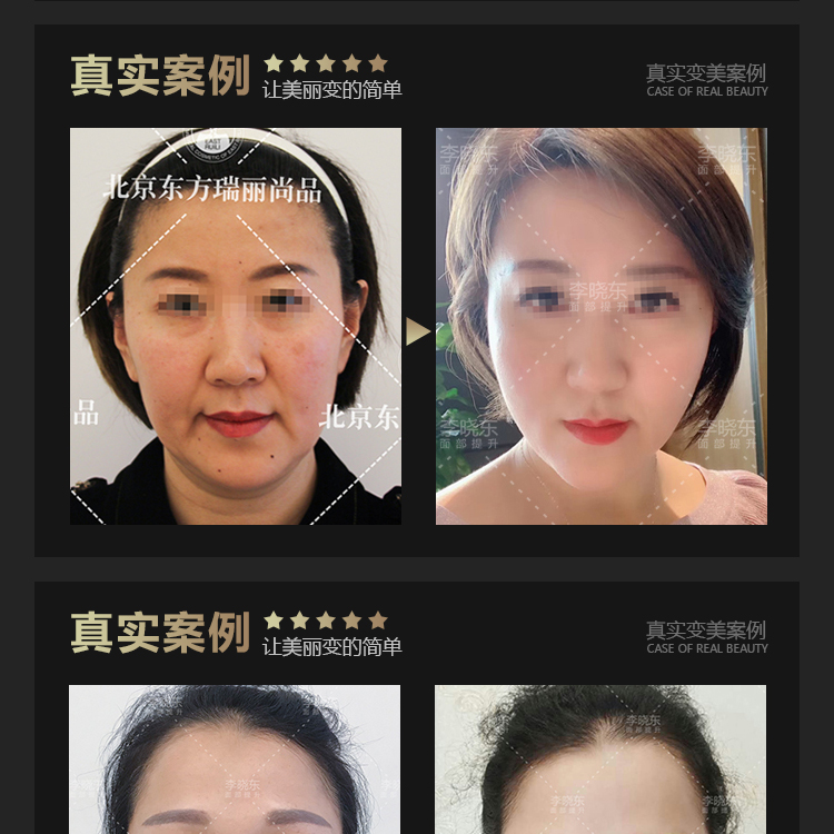 上海吕炜亮面部提升怎么样？闺蜜做了没踩坑，面部抗衰特色是脸不僵超自然