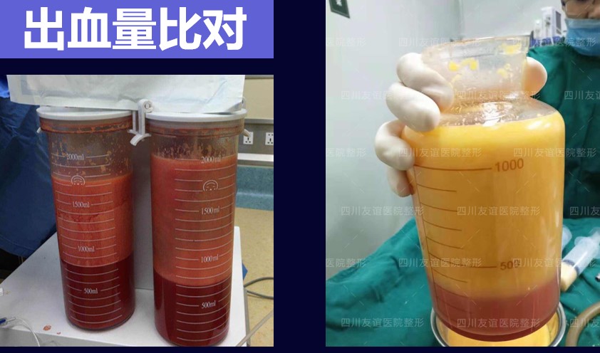王明利与乔爱军脂肪填充成活率谁更高?2025实测数据与用户反馈