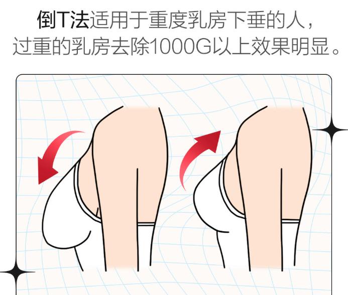 薛瑞和栗勇谁做大胸缩小手术好?薛瑞隆胸手法熟(成都后美亲测),栗勇缩胸病例多(杭州美莱靠谱)