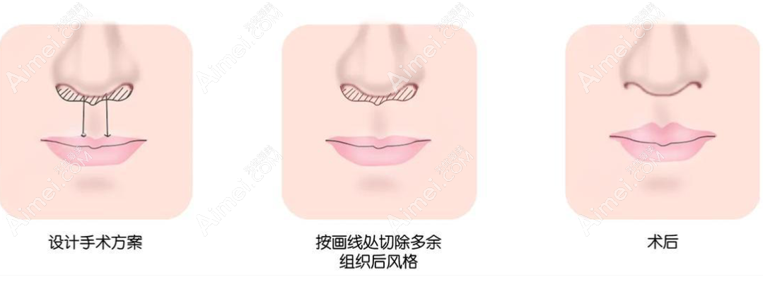 逐个解析上海人中缩短术好的医生 逐个解析上海人中缩短术好的医生