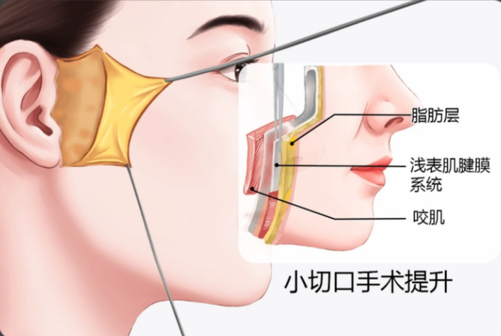 袁强拉皮手术怎么预约挂号