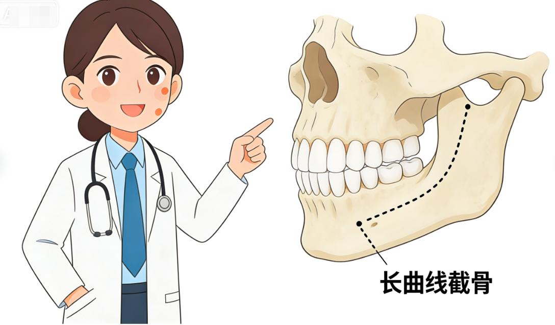 颧骨手术开刀位置3d演示