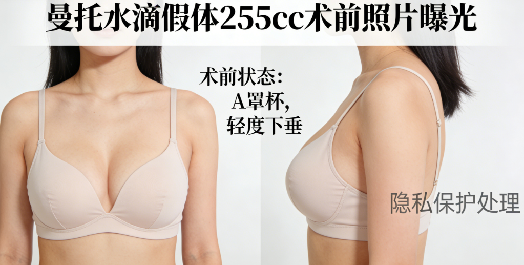 曼托水滴假体255cc前后照片对比