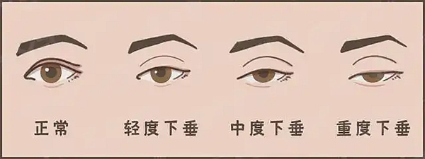 曹林双眼皮修复失败实例有哪些?经典含眼窝凹陷/线条不对称/疤痕增生/睑球分离/假大宽