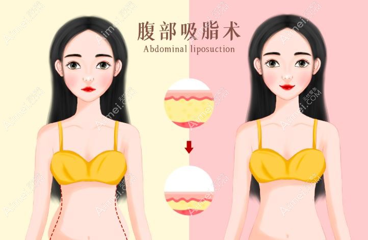 脂肪填充胡庆旭和王明利哪个更好？吸脂填充技术侧重点不同，王明利擅长……