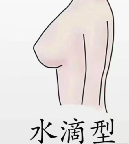 水滴假体隆胸要趴胸吗