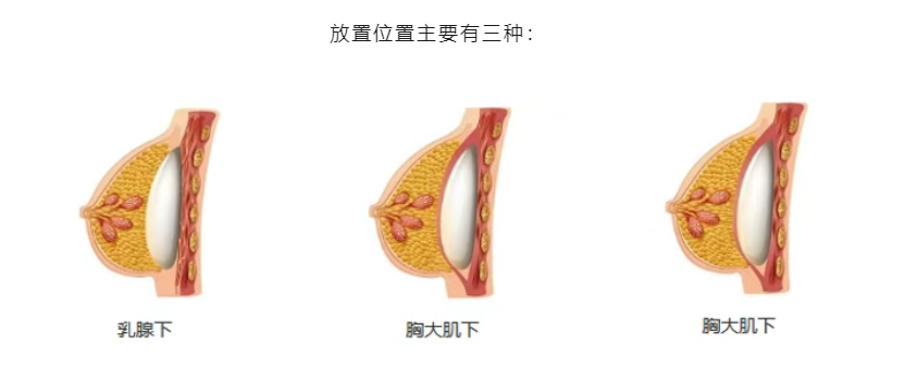 提醒:选假体别只看价格,透明 + 技术才是关键