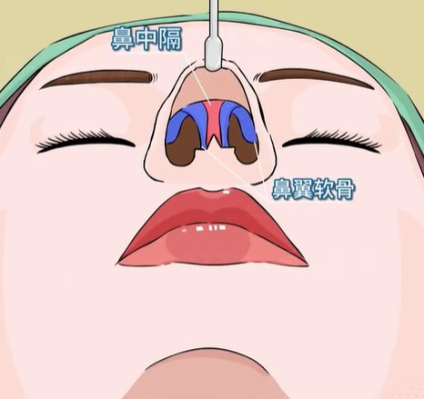 温科磊隆鼻术后护理：规避风险的关键步骤
