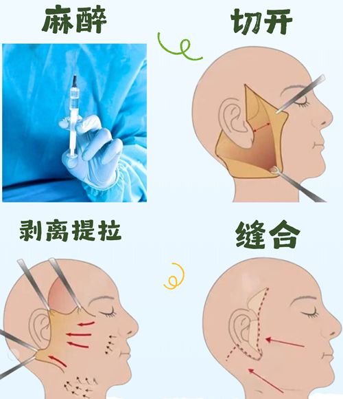 成都魏东医生筋膜提升价格公开！2.8万起做一次能维持5年+，真人术后无僵脸超自然