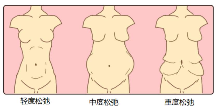 四、上海腹壁整形术后变好关键点