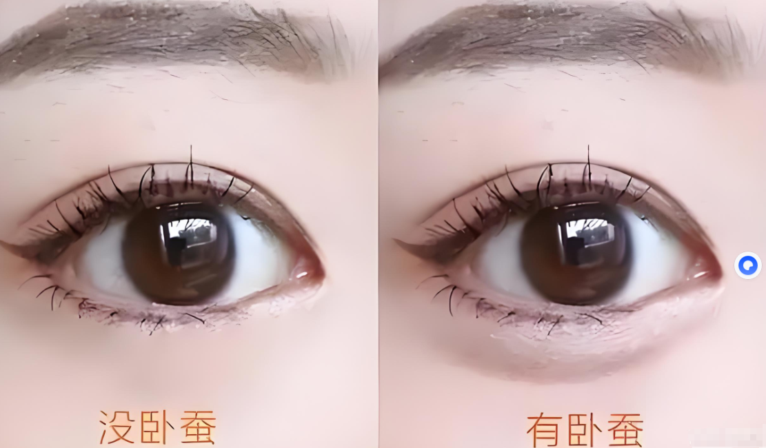 自体脂肪可以填充卧蚕吗?术后注意事项