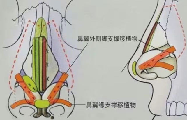 四、如何选择鼻翼缩小医生？关键对比维度