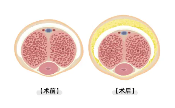 二、关于阴囊皮瓣转移覆盖阴茎延长术的收费与疗效,这几点要了解