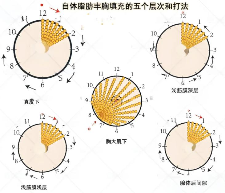 5. 临沂艺星医疗美容医院——数字化隆胸“疗效先知”