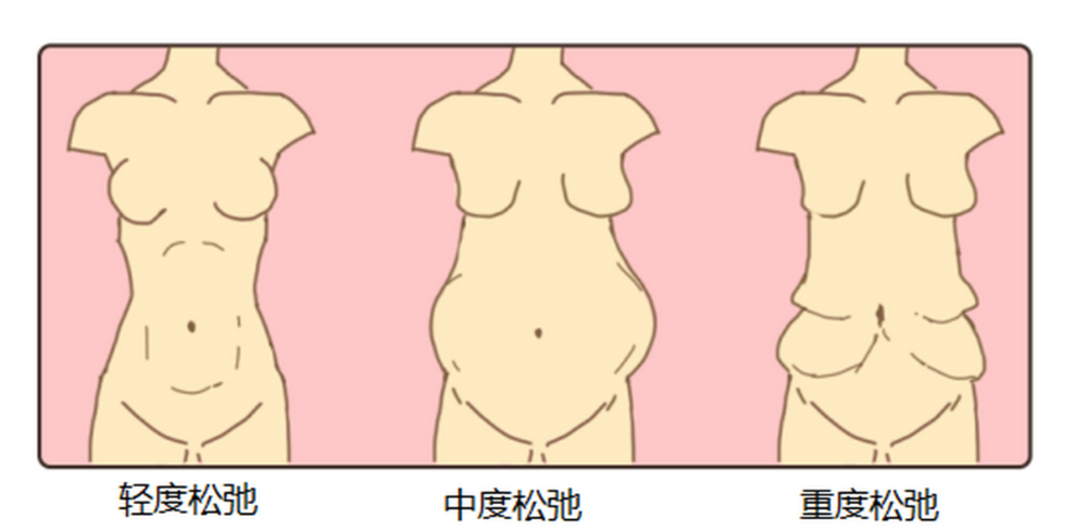 160斤能做梁红伟腹壁整形吗?真实实例见证术后疗效
