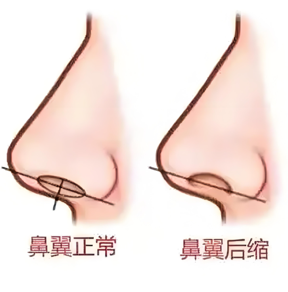 二、关于上海张贺医生做鼻翼缘疗效不错的收费，这几点要了解