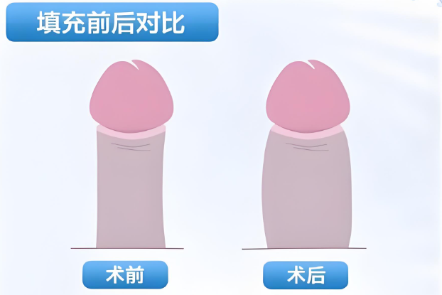 四、想了解重庆吕巍3D超凝晶增粗术如何的医生团队？这份资料别错过