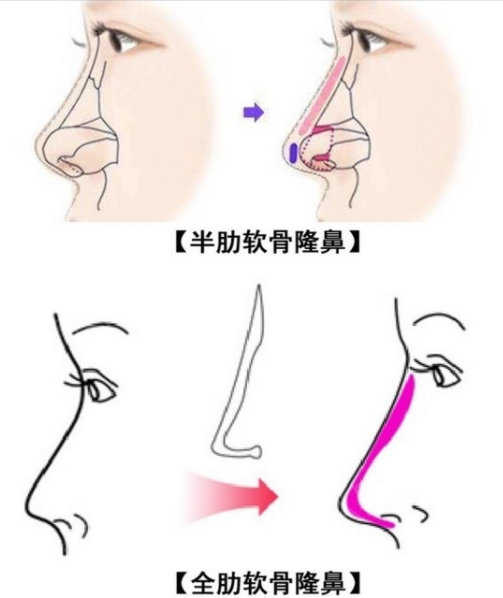 呼市隆鼻哪家好？韩赋整形，妈生感直鼻大拿，自然到亲妈看不出
