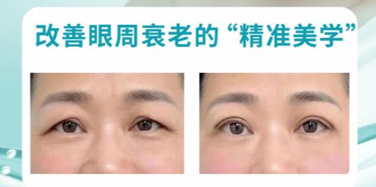 三、李力群医背书:老炮坐诊,无痕提眉靠手艺说话