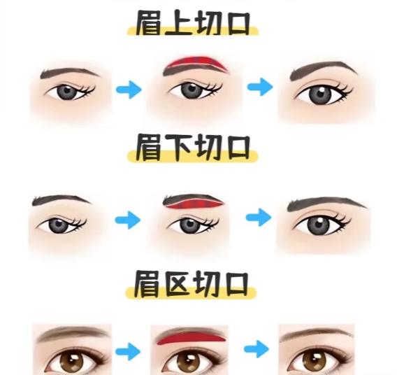 李力群医生提眉实例: 下垂眼皮终于有救了,几乎还看不出手术痕迹
