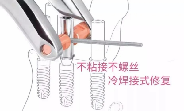 一、北京劲松口腔光华路分院种牙怎么样?正规不踩坑