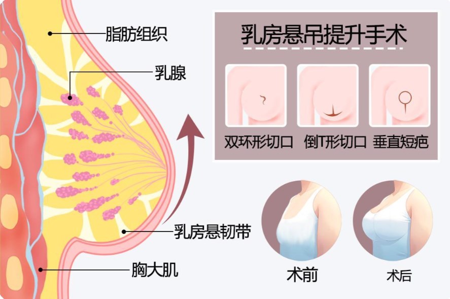 四、葛海辉隆胸手术前需要了解的几个关键问题www.dlren.com