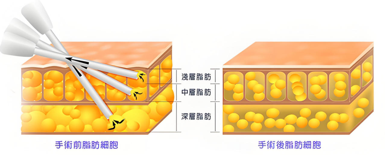 五、 问答板块:关于武汉艺星吸脂的避坑建议