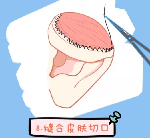 三、 从一度二度小耳看刘嘉锋医生耳朵舒展怎么样