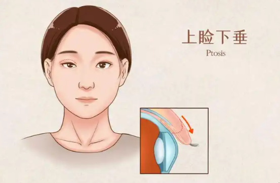 郑永生上眼睑下垂vs眼袋修复案例!哪个项目更适合你?眼部问题一站式解决!