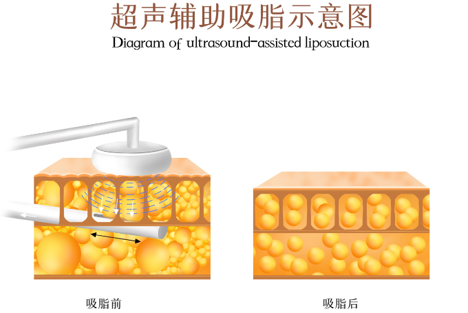上海宋建星吸脂手术价格表2026年解析,8000元-99800元起是真的吗?技术/部位/套餐三大维度拆解收费明细